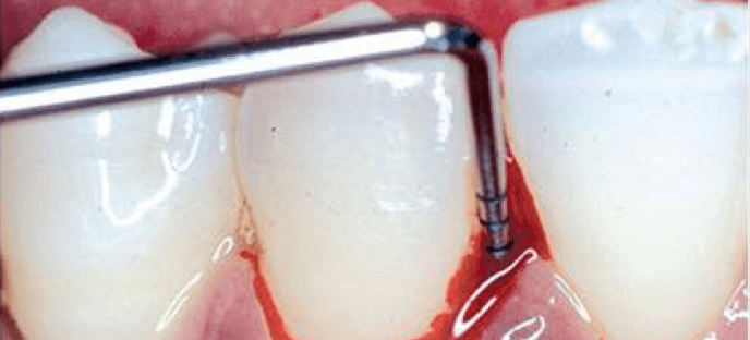 Teeth with bleeding gums and dentist's tool