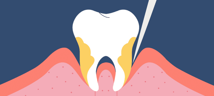 Tooth with plaque and dental tool