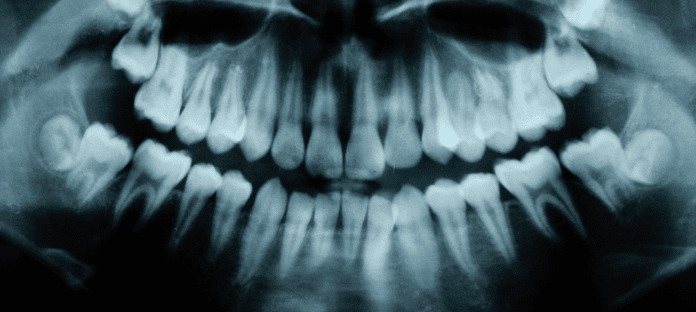 X-ray of teeth