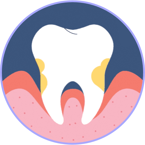 Tooth with moderate amount of plaque and moderately swollen, red, and receding gums