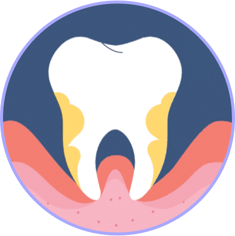 Tooth with a lot of plaque