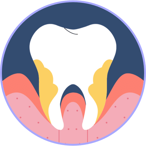 Tooth with plaque and receding gumline